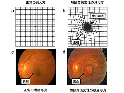 人間ドック/健診センターに来診する40~50代の患者に向けた「加齢黄斑変性」啓蒙冊子のサンプリング事例3